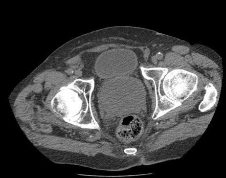 Adenoma da próstata nos homens: etiologia, clínica e métodos de diagnóstico.