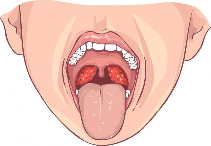 O que distingue angina de faringite e laringite