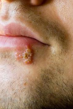 razão de herpes