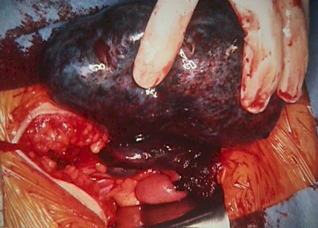 Cisto de ovário endomiperóide - o que é tratar de tratar