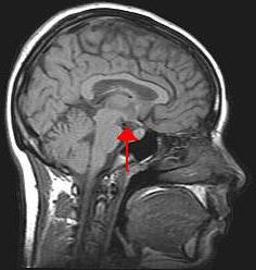 Hypothalamus e glândula pituitária