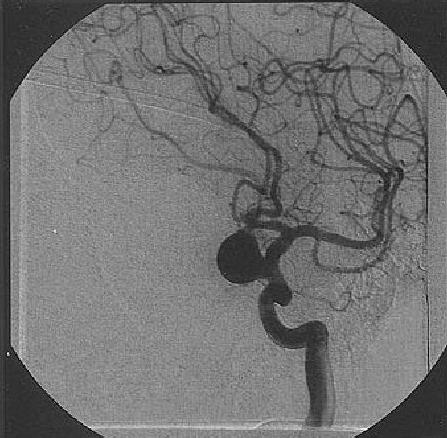 Acidente vascular cerebral Sintomas e tratamento