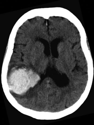 Acidente vascular cerebral Tratamento. Medicamentos