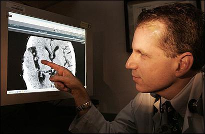 Acidente vascular cerebral Medicação de tratamento