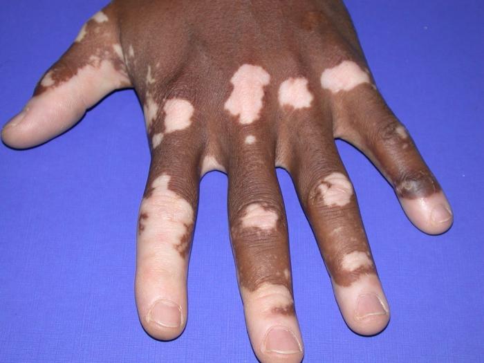 Quais são os sintomas e causas do vitiligo?