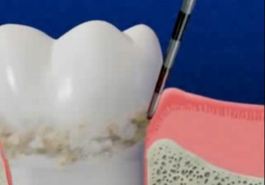 Classificação de periodontite, causas, diagnóstico, tratamento