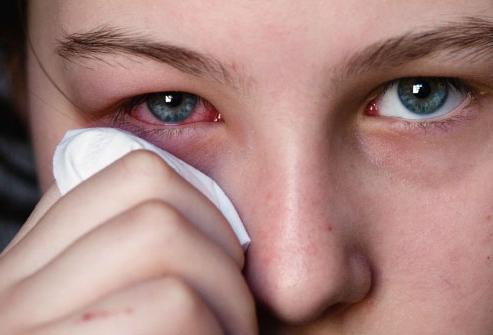 pomada de hematomas sob os olhos