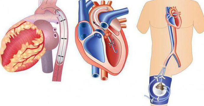 Cuidados de emergência para choque cardiogênico: um algoritmo de ação. Brigade de Emergência de Ressuscitação