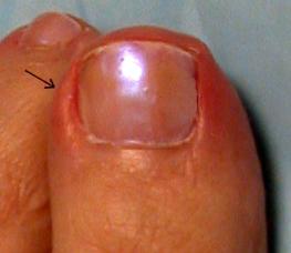 A unha cresceu em um dedo: as causas e o tratamento