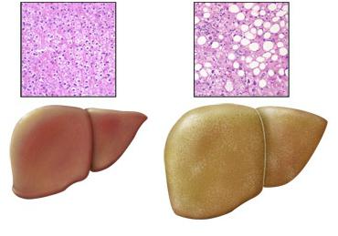 obesidade do fígado do que tratar