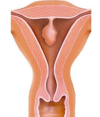 Hiperplasia, polipose endometrial