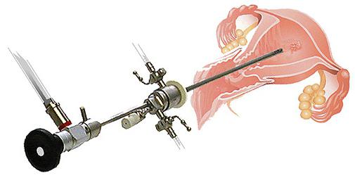 Polipose endometrial, tratamento