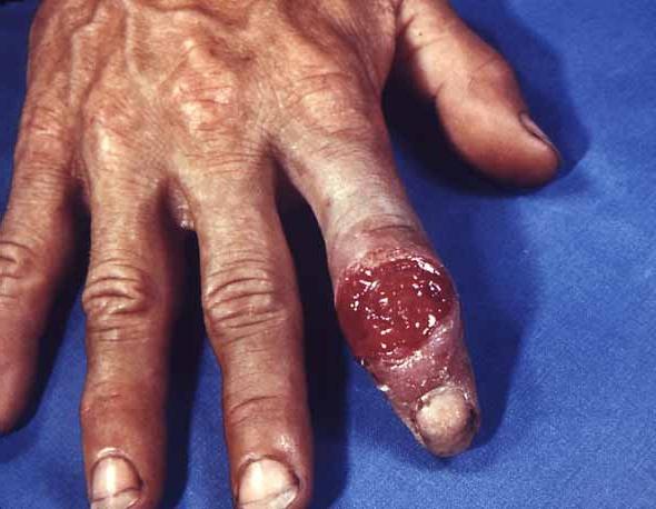 Sífilis: um sintoma da doença e do tratamento
