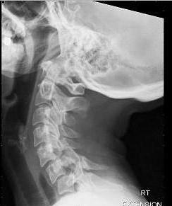 síndrome da artéria vertebral com osteocondrose cervical